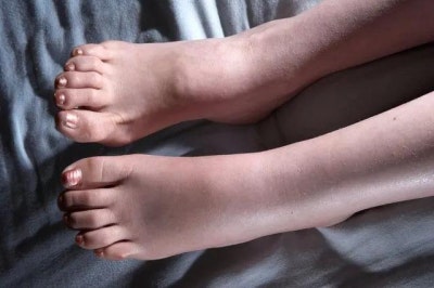 붓기와 통증,호르몬의 변화가 보낸 신호 붓기와 통증,호르몬의 변화가 보낸 신호